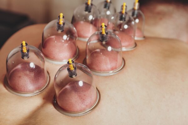 Cupping cups applied to back during wellness session Nelson & Pendle
