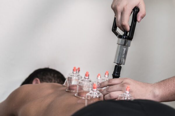 Therapist performing professional cupping treatment in Nelson & Pendle